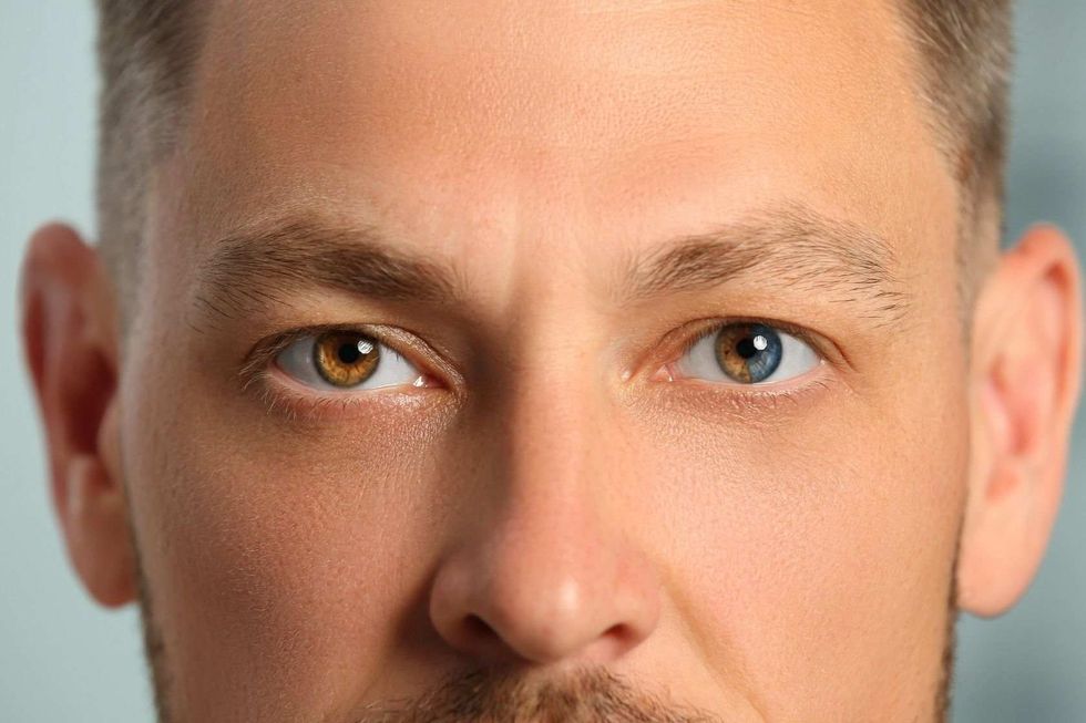 Man with eyes of different colors heterochromia iridis